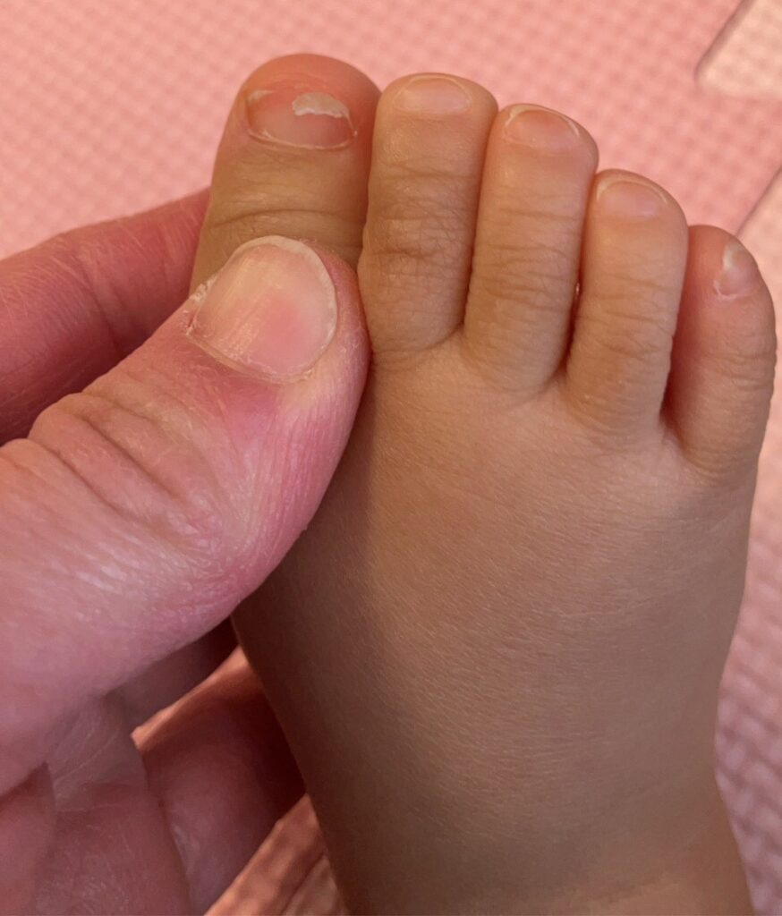 園児の割れた爪